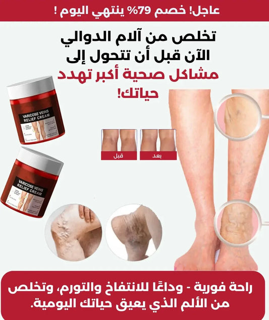 مرهم علاج الدوالي