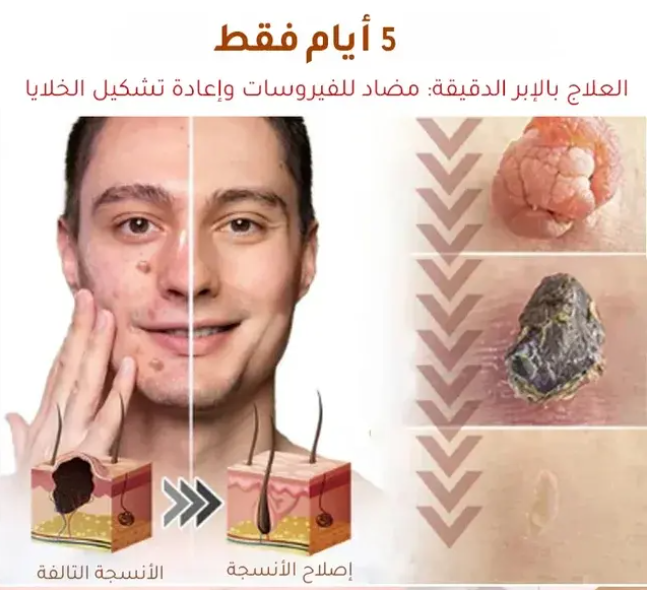 لاصقات معالجة الثآليل